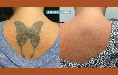 removery tattoo removal & fading|removery tattoo removal locations.